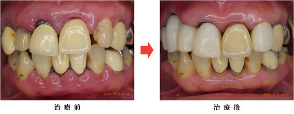 ぺリオメント.SA-Iの症例重度の歯周病治療（ペリオメント）前後（45歳 女性）