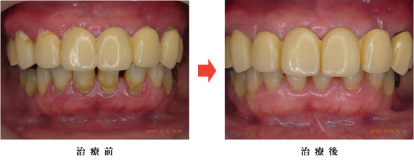 ぺリオメント.SA-Iの症例重度の歯周病治療（ペリオメント）前後（41歳 女性）