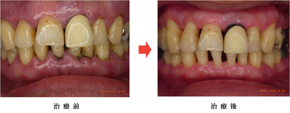 ぺリオメント.SA-Iの症例重度の歯周病治療（ペリオメント）前後（37歳 男性）