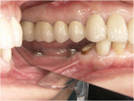 人工歯根の埋入（下顎）