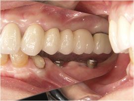 人工歯根の埋入（下顎）