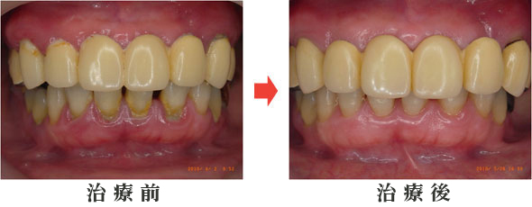 ぺリオメント.SA-Iの症例重度の歯周病治療(ペリオメント)前後(41歳 女性)